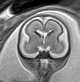 Normal brain fetal MRI - 22 weeks (Radiopaedia 50623-56050 Coronal T2 Haste 15).jpg