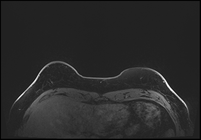 Normal breast MRI - dense breasts (Radiopaedia 80454-93850 C 19).jpg
