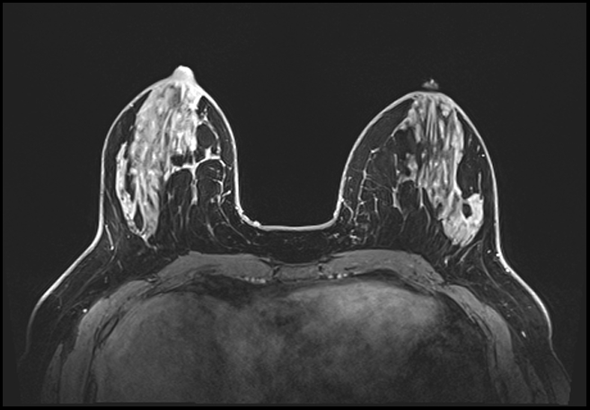 Normal breast MRI - dense breasts (Radiopaedia 80454-93850 C 85).jpg