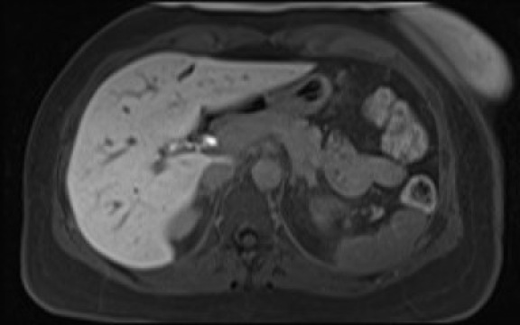 File:Normal hepatobiliary phase liver MRI (Radiopaedia 58968-66230 A 41).jpg