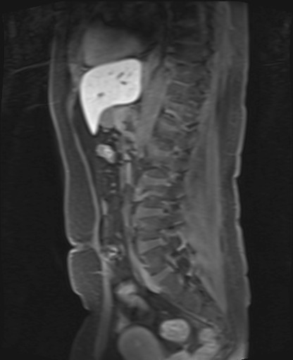 File:Normal hepatobiliary phase liver MRI (Radiopaedia 58968-66230 C 45).jpg