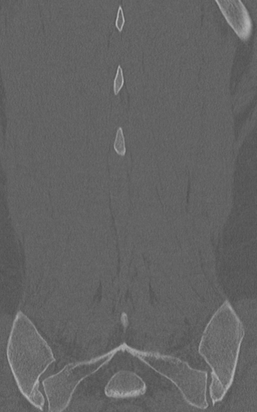 Normal lumbar spine CT (Radiopaedia 46533-50986 Coronal bone window 69).png