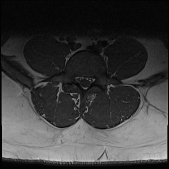 File:Normal lumbar spine MRI (Radiopaedia 47857-52609 Axial T1 21).jpg