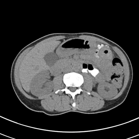 File:Normal multiphase CT liver (Radiopaedia 38026-39996 Axial non-contrast 37).jpg