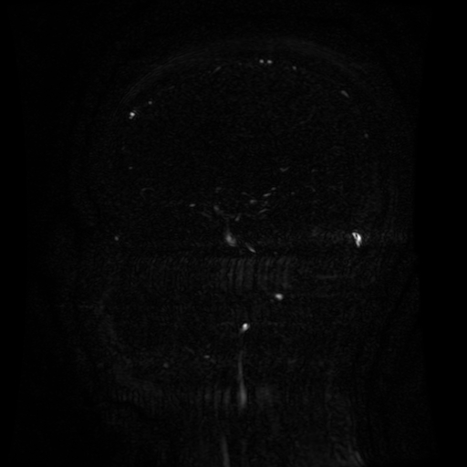 Normal noncontrast MR venography (Radiopaedia 87578-103957 A 106).jpg