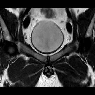 File:Normal prostate (MRI) (Radiopaedia 29986-30535 Coronal T2 2).jpg