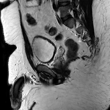 File:Normal prostate (MRI) (Radiopaedia 29986-30535 Sagittal T2 7).jpg