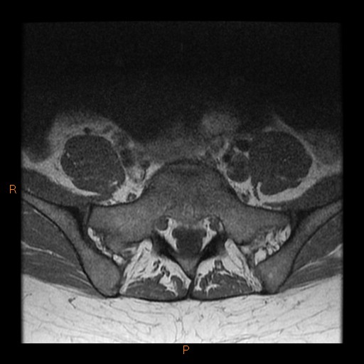 File:Normal spine MRI (Radiopaedia 77323-89408 Axial T1 26).jpg