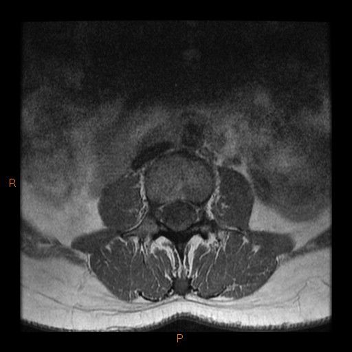 File:Normal spine MRI (Radiopaedia 77323-89408 Axial T1 4).jpg