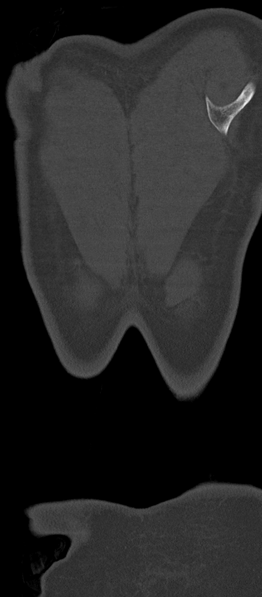 Normal thoracolumbar spine (Radiopaedia 43822-47309 Coronal bone window 93).png