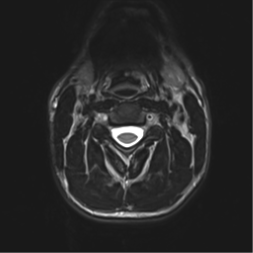 Normal trauma cervical spine (Radiopaedia 41017-43762 D 16).png