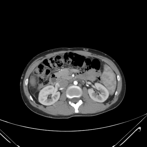 File:Nutmeg liver- Budd-Chiari syndrome (Radiopaedia 46234-50635 A 34).png