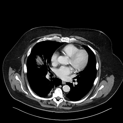 Obstructing sigmoid adenocarcinoma (Radiopaedia 58465-65619 A 5).jpg