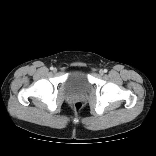 File:Obstructing ureteric calculus (Radiopaedia 18615-18514 B 55).jpg