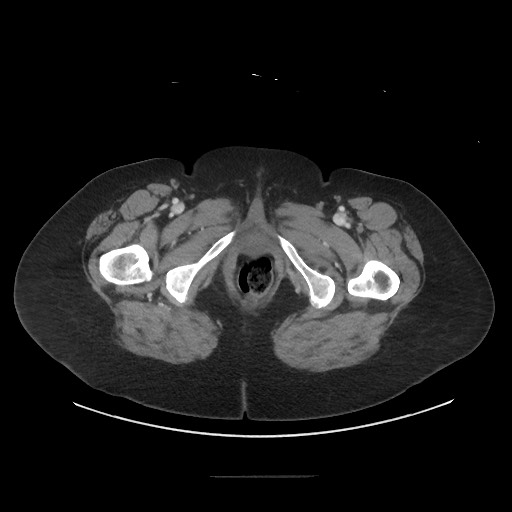 Obstructive distal colonic adenocarcinoma causing cecal perforation (Radiopaedia 86830-102989 A 200).jpg