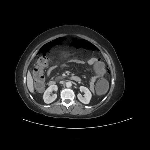 Obstructive distal colonic adenocarcinoma causing cecal perforation (Radiopaedia 86830-102989 A 83).jpg