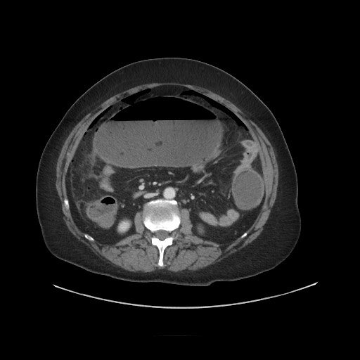 Obstructive distal colonic adenocarcinoma causing cecal perforation (Radiopaedia 86830-102989 A 98).jpg
