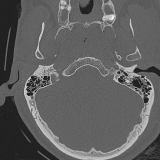 File:Occipital condyle fracture (Radiopaedia 33467-34517 Axial bone window 12).png