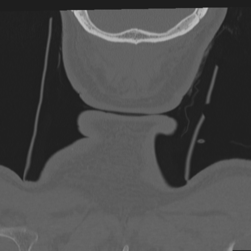 File:Occipital condyle fracture (Radiopaedia 33467-34517 Coronal bone window 78).png