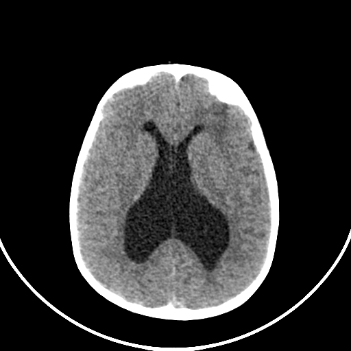 Occipital encephalocele (Radiopaedia 87339-103636 Axial non-contrast 49).jpg