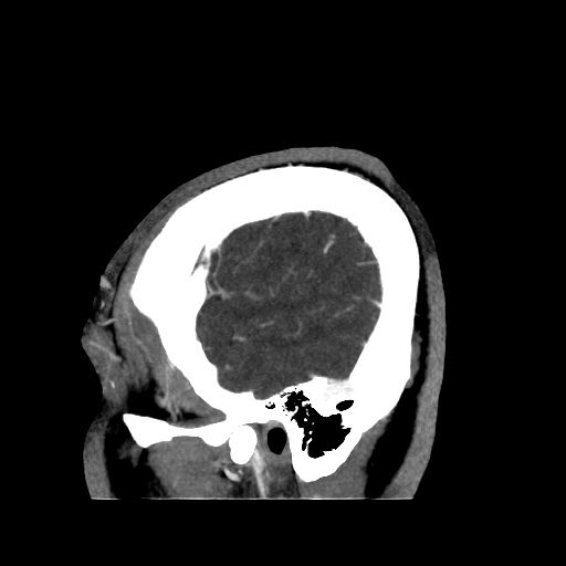 Occipital extradural hematoma simulating venous sinus thrombosis (Radiopaedia 46514-50964 D 10).jpg