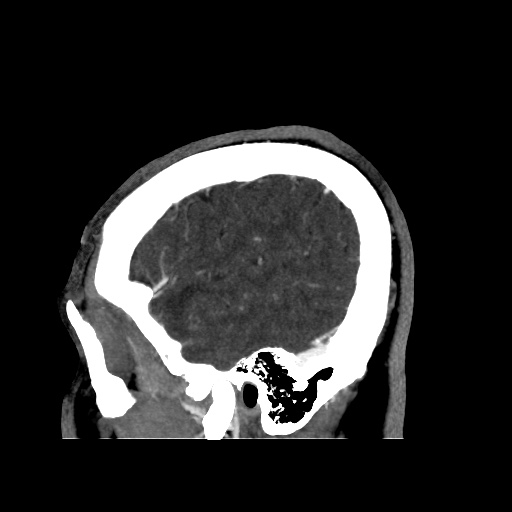 Occipital extradural hematoma simulating venous sinus thrombosis (Radiopaedia 46514-50964 D 67).jpg