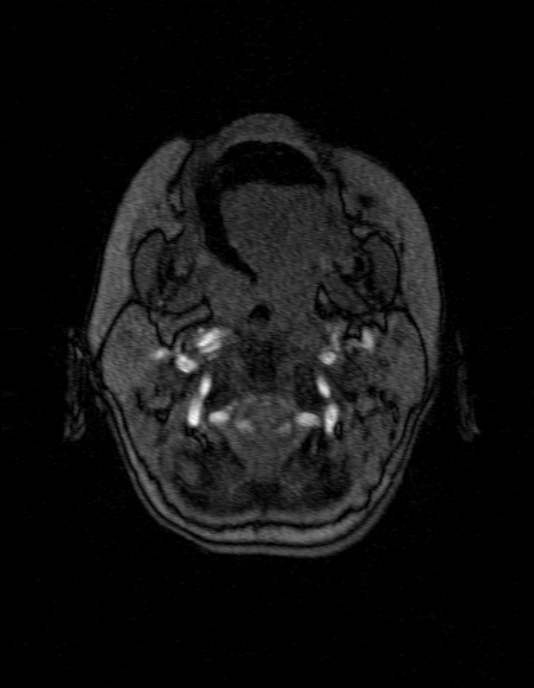 Occipital horn syndrome (Radiopaedia 14255-14129 MRA 7).jpg