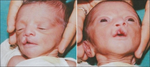 13-day-old infant with cleft lip