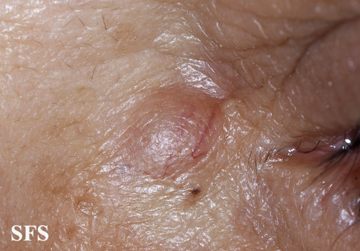 File:Trichoblastoma (Dermatology Atlas 3).jpg