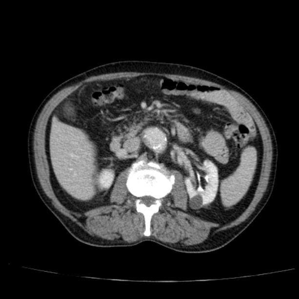 Abdominal aortic aneurysm (Radiopaedia 29248-29660 Axial C+ portal venous phase 26).jpg