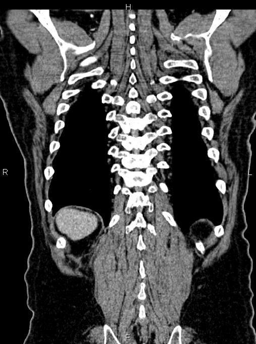 Abdominal aortic aneurysm (Radiopaedia 83094-97462 Coronal renal cortical phase 79).jpg