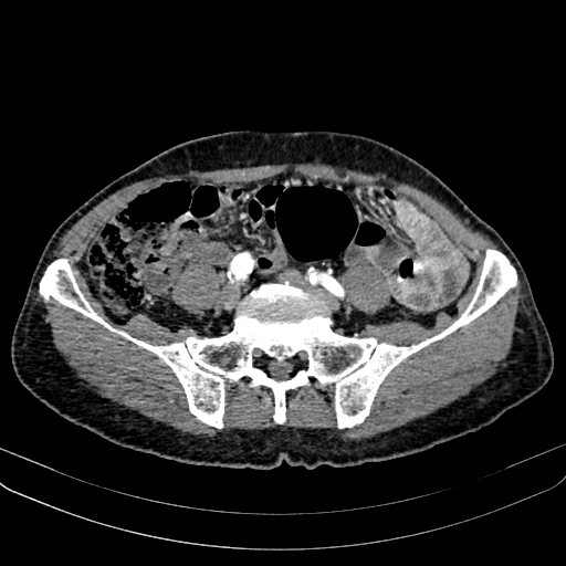 Abdominal aortic aneurysm (Radiopaedia 83581-98689 Axial C+ arterial phase 83).jpg
