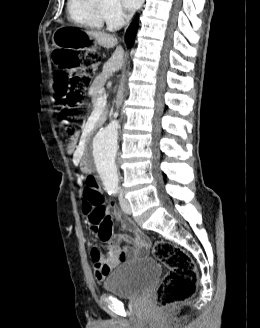 Abdominal aortic aneurysm (Radiopaedia 83581-98689 Sagittal C+ portal venous phase 48).jpg