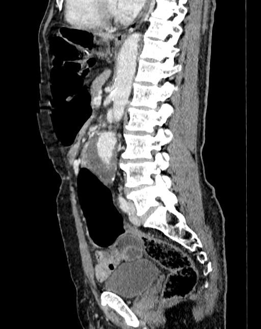 Abdominal aortic aneurysm (Radiopaedia 83581-98689 Sagittal C+ portal venous phase 61).jpg
