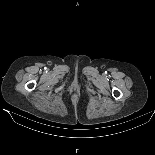 File:Abdominal aortic aneurysm (Radiopaedia 85063-100606 Axial C+ arterial phase 71).jpg