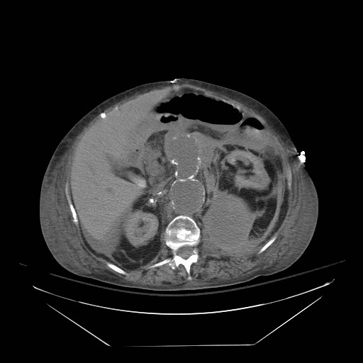 Abdominal aortic aneurysm - impending rupture (Radiopaedia 19233-19247 Axial non-contrast 68).jpg