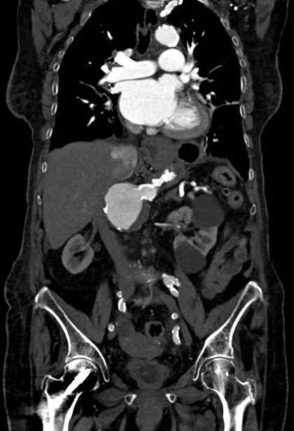 Abdominal aortic aneurysm with thrombus fissuration (Radiopaedia 73192-83919 Coronal C+ arterial phase 43).jpg