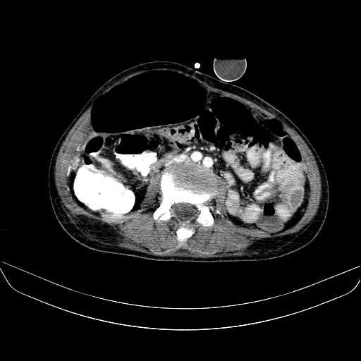 File:Abdominal collection due to previous cecal perforation (Radiopaedia 80831-94320 Axial C+ portal venous phase 112).jpg
