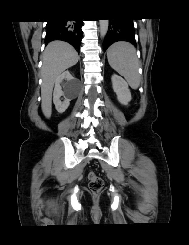 Abdominal lymphoma - with sandwich sign (Radiopaedia 53486-59492 C+ portal venous phase 14).jpg