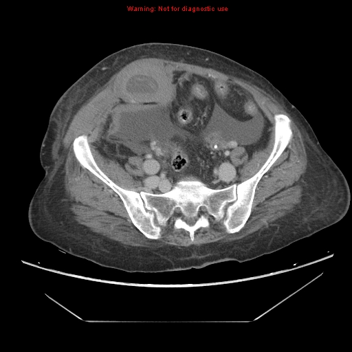 File:Abdominal wall hematoma (Radiopaedia 9427-10112 Axial C+ portal venous phase 81).jpg