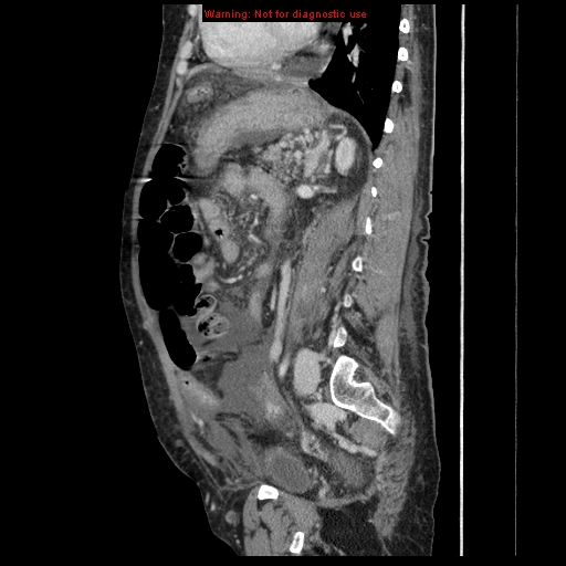 Abdominal wall hematoma (Radiopaedia 9427-10112 Sagittal C+ portal venous phase 40).jpg