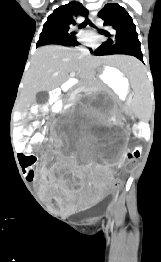 Abdominopelvic rhabdomyosarcoma (Radiopaedia 78356-90984 Coronal C+ portal venous phase 46).jpg