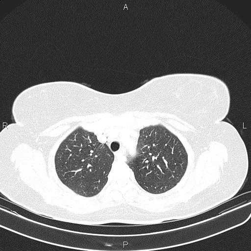 Aberrant right subclavian artery (Radiopaedia 87334-103629 Axial lung window 20).jpg