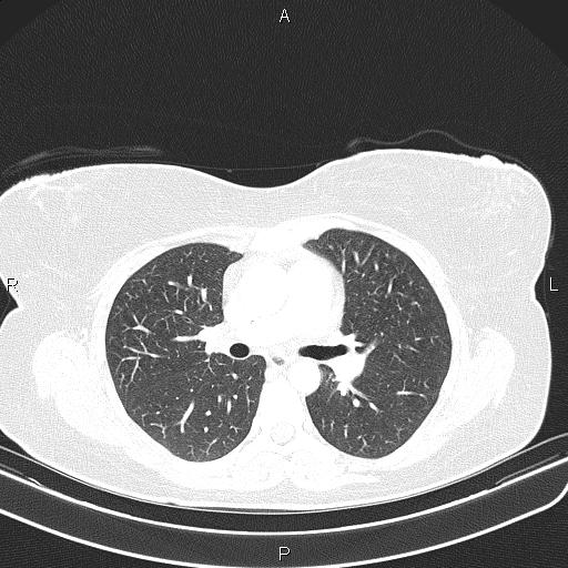 File:Aberrant right subclavian artery (Radiopaedia 87334-103629 Axial lung window 31).jpg