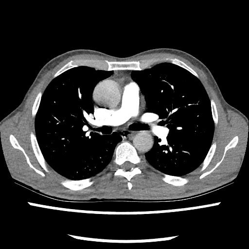 Accessory left horizontal fissure with lingular pneumonia (Radiopaedia 53763-59843 Axial C+ CTPA 43).jpg