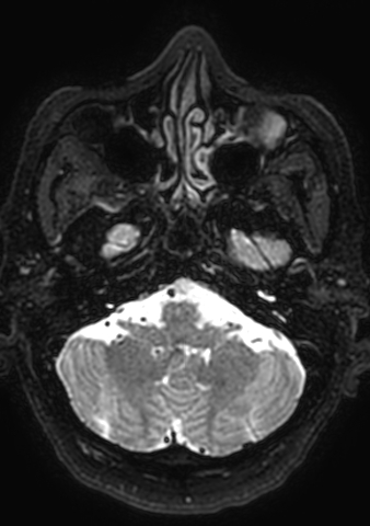 Accessory middle cerebral artery (Radiopaedia 73114-83828 Axial T2 177).jpg