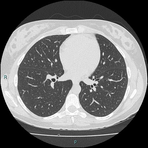File:Accidental foreign body aspiration (seamstress needle) (Radiopaedia 77740-89983 Axial lung window 38).jpg