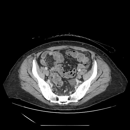 Acinar cell carcinoma of the pancreas (Radiopaedia 75442-86669 Axial C+ portal venous phase 118).jpg