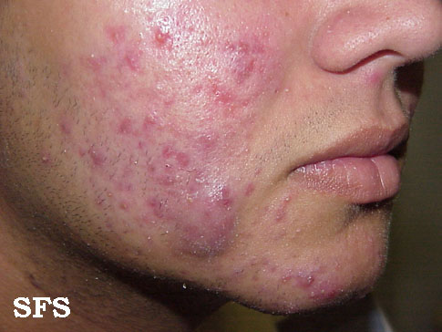 File:Acne (Dermatology Atlas 3).jpg