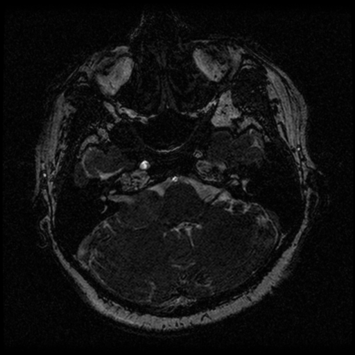 Acoustic schwannoma (Radiopaedia 33045-34060 Axial T2 23).png